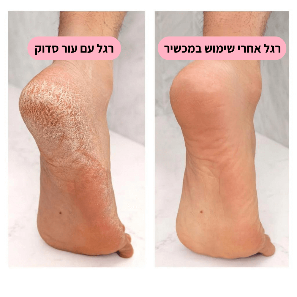 מכשיר פדיקור מבית Shoplilo | רגליים נקיות וחלקות תוך 5 דקות